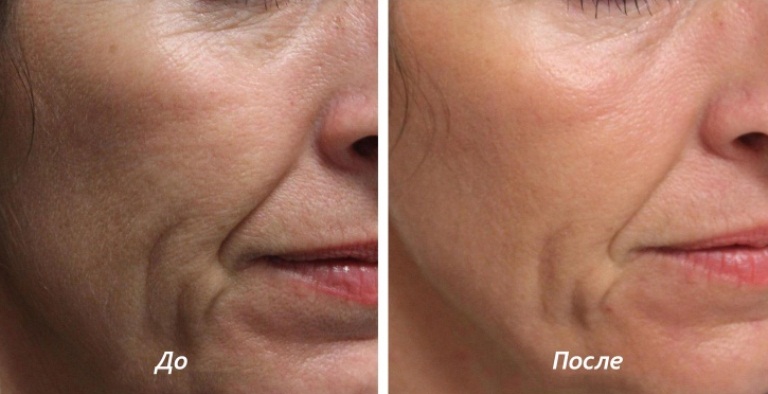 лазерная биоревитализация – что это такое фото