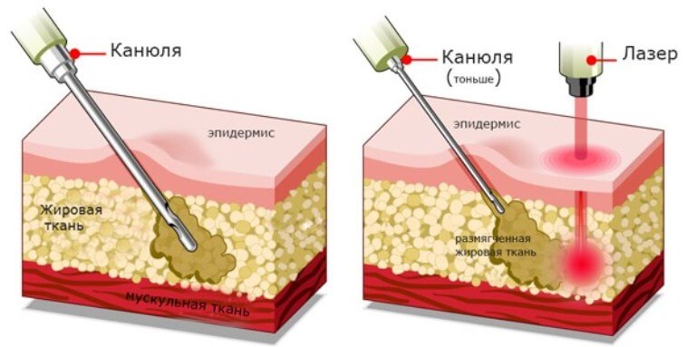 Лазерная липосакция бедер