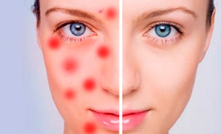 На лице появились подкожные прыщи, что делать и как лечить?