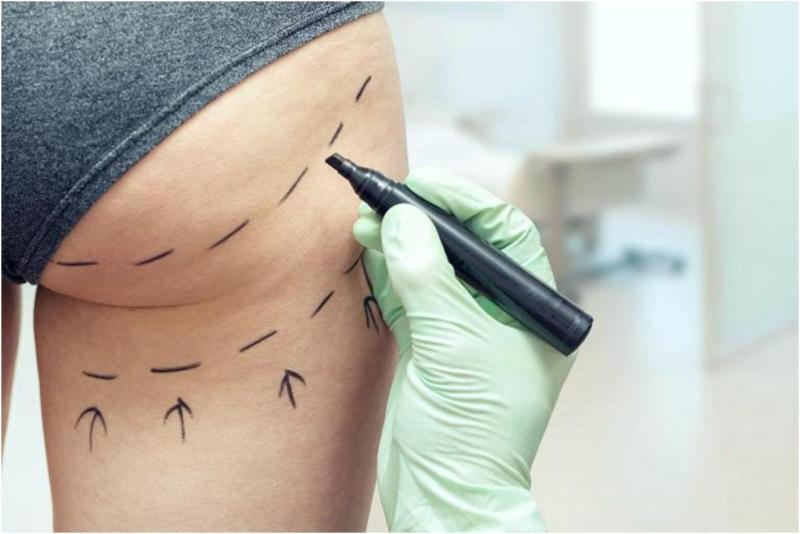 Разметка на ягодицах