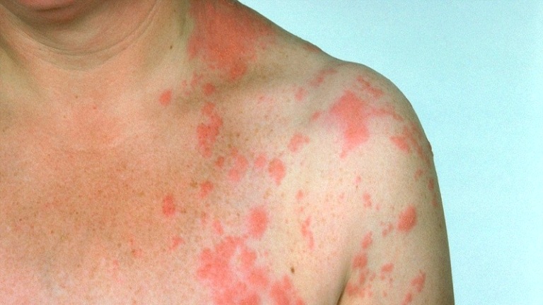 Лишай у человека