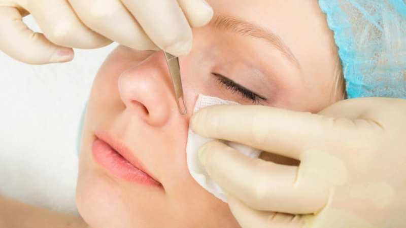 Выдавливать угри на лице в салоне