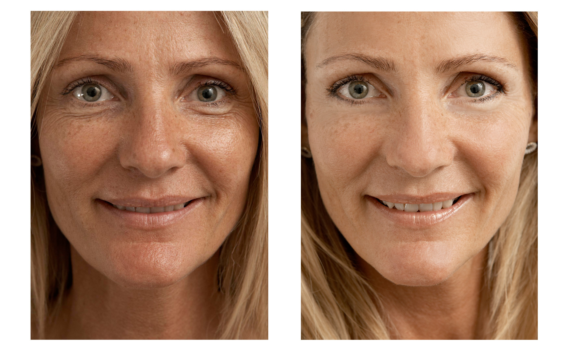 Ревитализация до и после 2