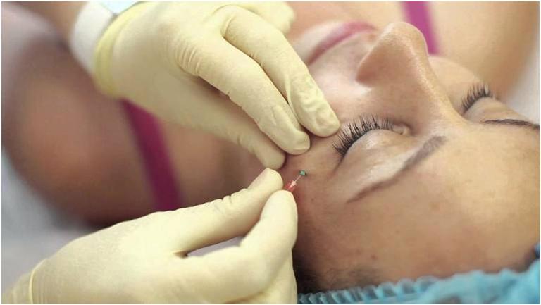 Вживление мезонитей для подтяжки лица