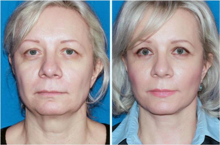 До и после подтяжки лица мезонитями