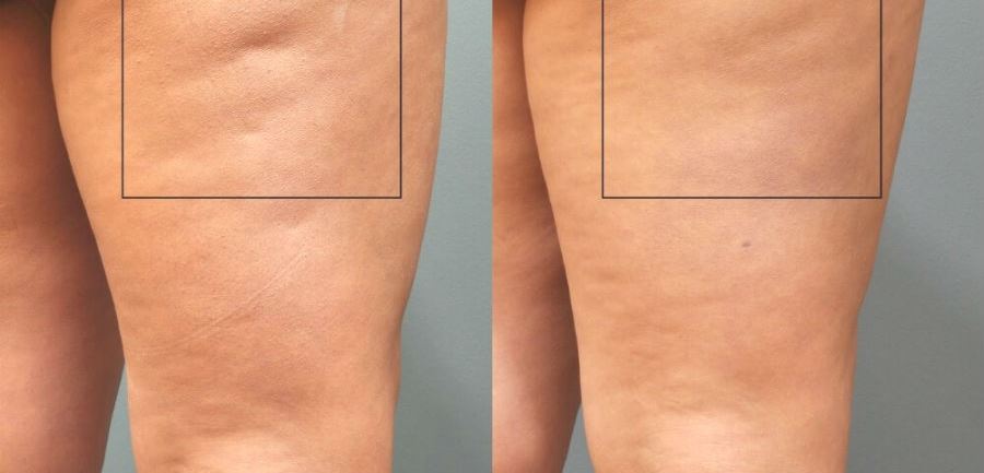 вакуумно-роликовый массаж: до и после