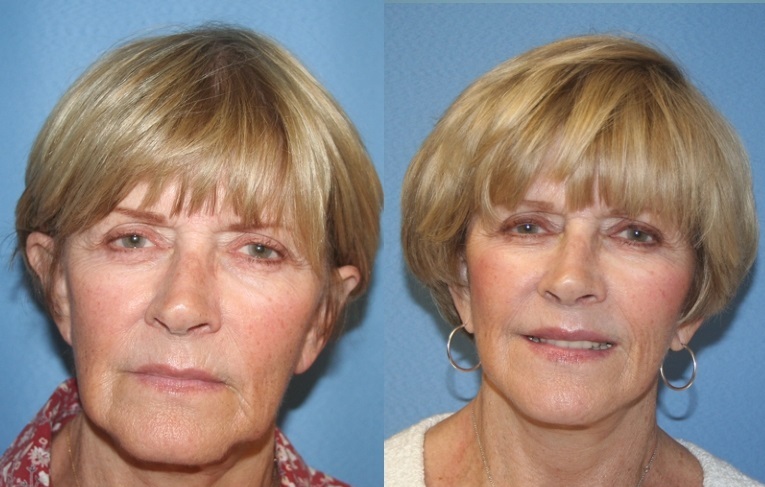 Миостимуляция лица: фото до и после