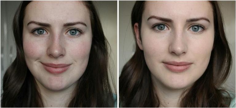 До и после Нано Ботокса