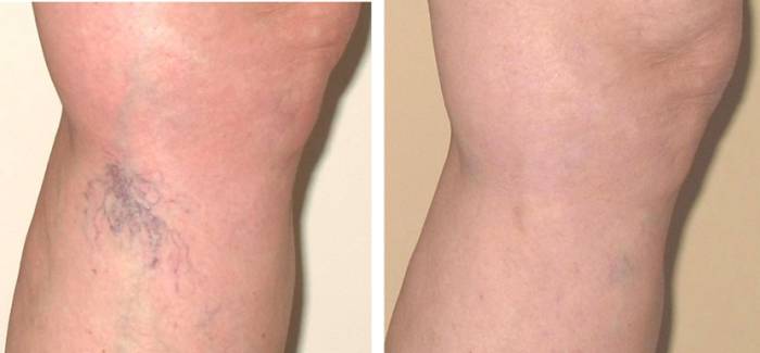 фото до и после склеротерапии