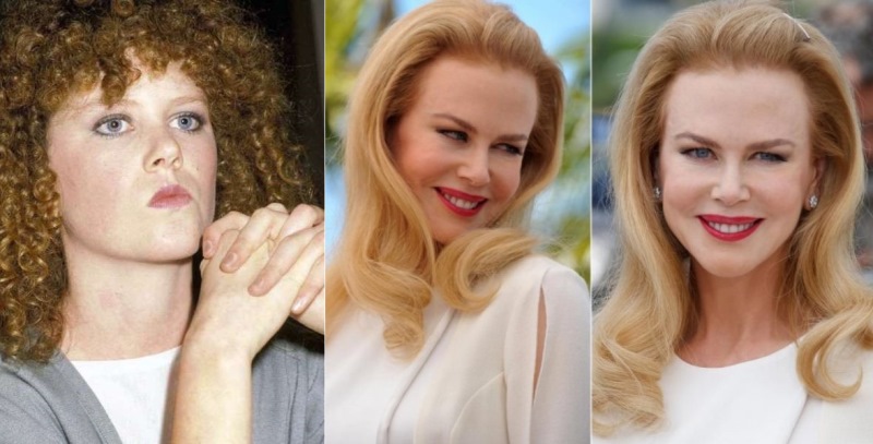 Николь Кидман до и после операции