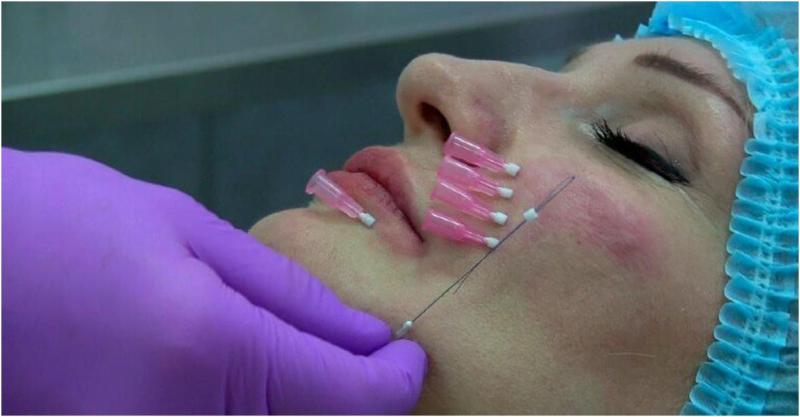 Внедрение нитей для подтяжки лица