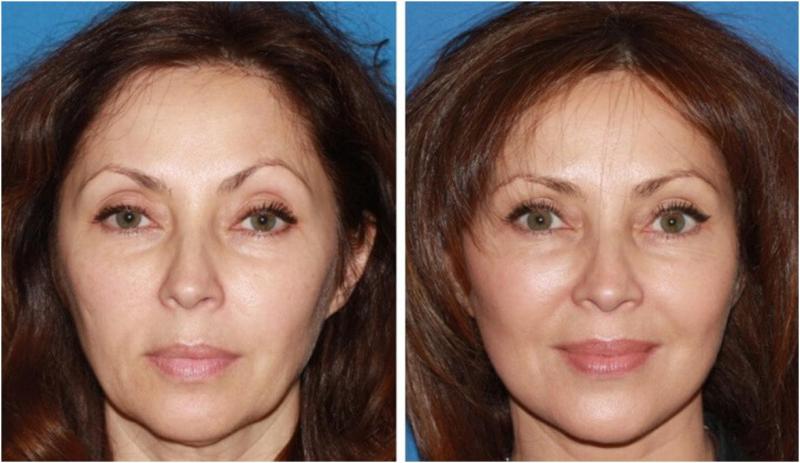 Фото до и после подтяжки лица нитями