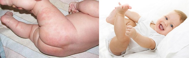 Кожный дерматит и все про него