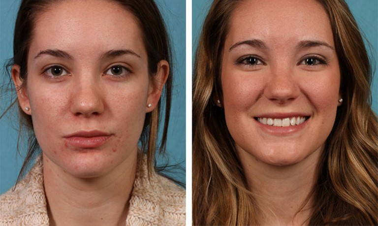 До и после пилинга