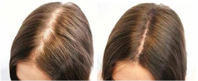 До и после плазмолифтинга для волос
