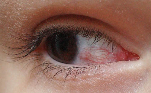 Прыщи на глазах – какие причины?