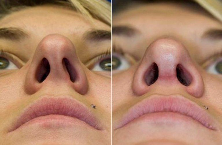 Смещение носовой перегородки