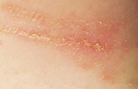 SHelushenie-vospalennyh-uchastkov