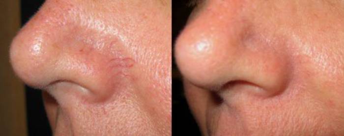 купероз избавление