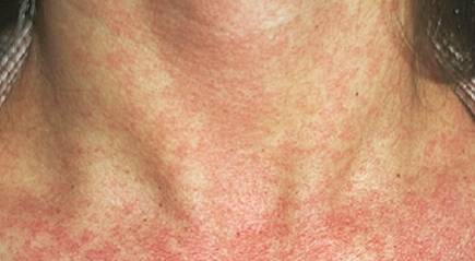 simptomy-krasnuxi-u-vzroslyx