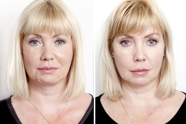 Ревитализация до и после