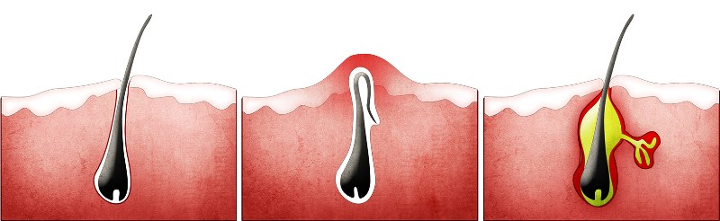 Вросшие волосы с воспалением