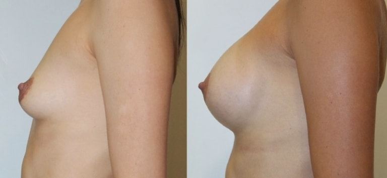 До и после установки грудных имплантов