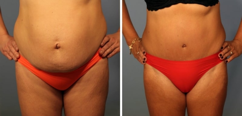 фото до и после абдоминопластики живота у женщины