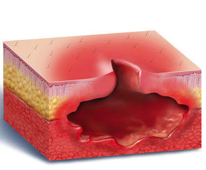 Что делать когда вскрылся фурункул