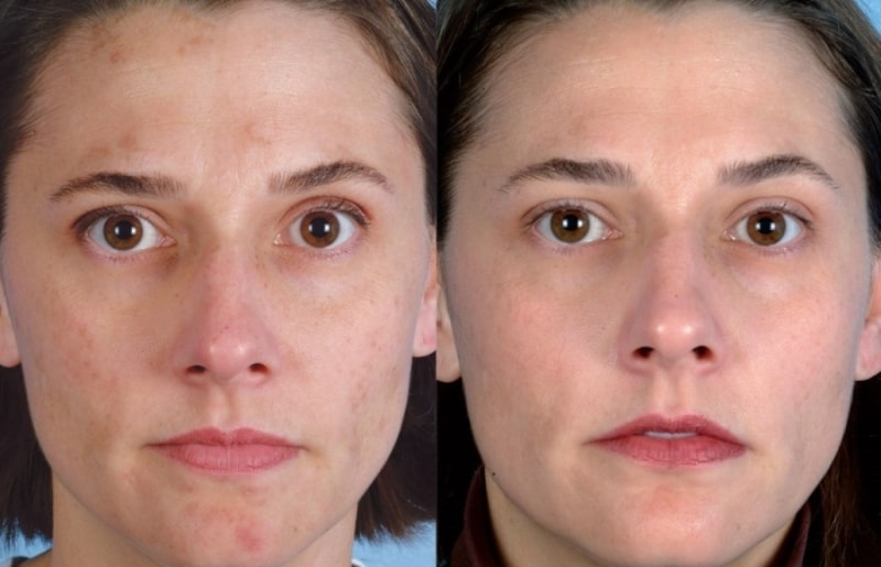 PRX t33 пилинг до и после