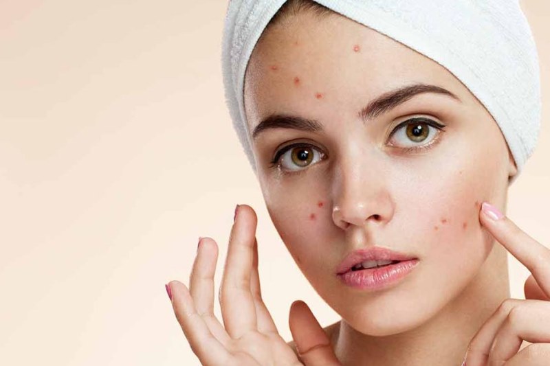 Девушка с прыщами