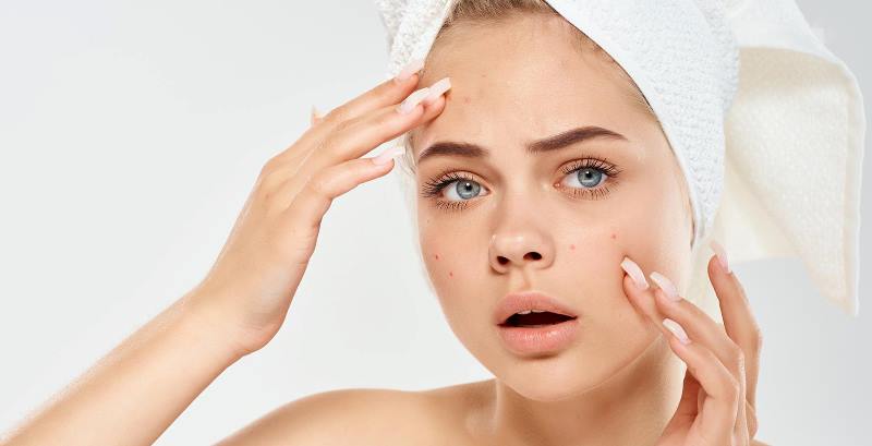 Акне на лице