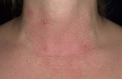 аллергический дерматит