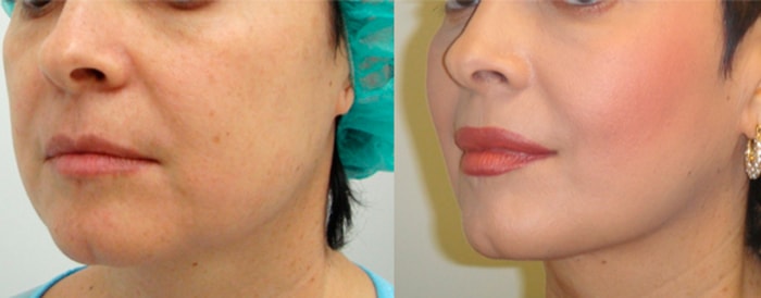 нити аптос для подтяжки до и после