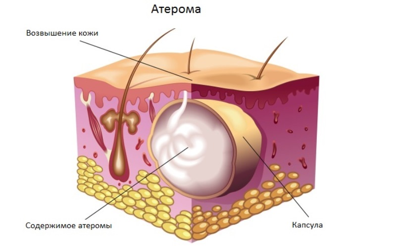 схема атеромы на лице