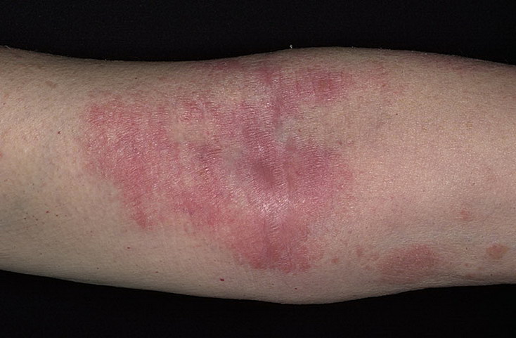 atopicheskii_dermatit-foto