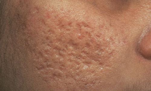 Какое средство от рубцов от прыщей самое эффективное