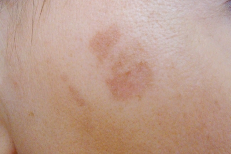Лентиго на лице