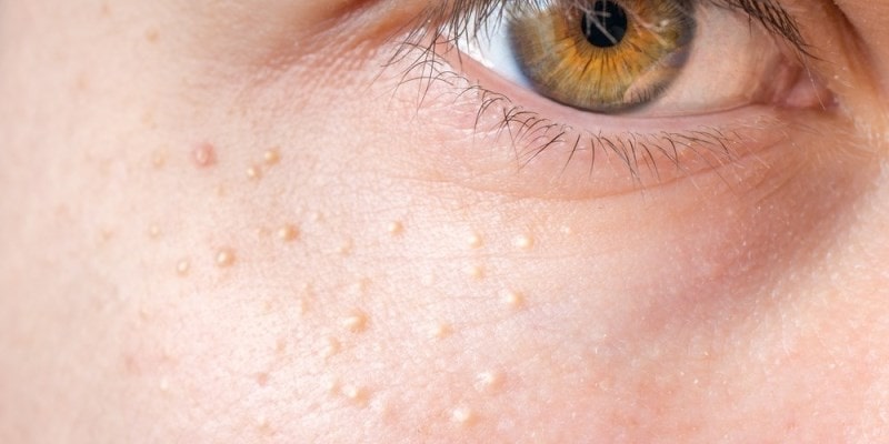 милиумы на лице возле глаза