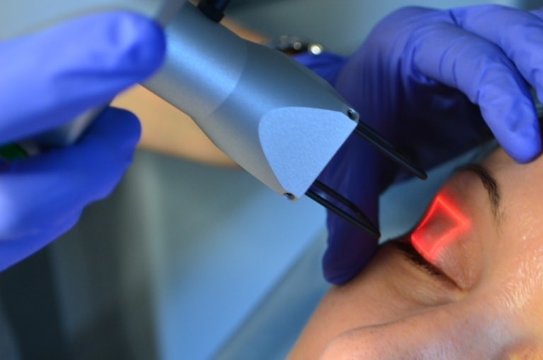 Лазерная блефаропластика