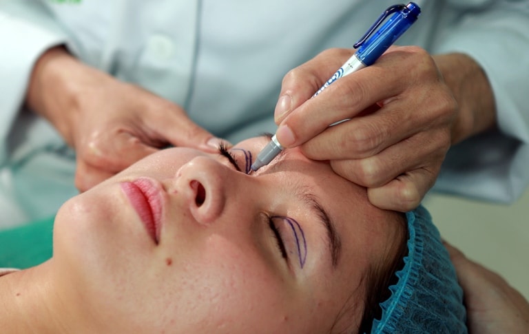 Подготовка к лазерной блефаропластики