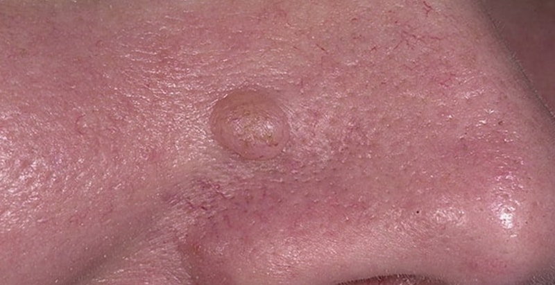 Базалиома на носу