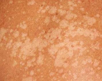 белые пятна отрубевидный лишай фото