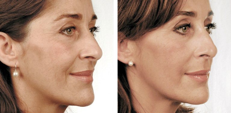 До и после биоревитализации