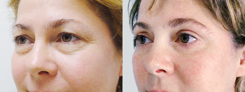 фото до и после блефаропластики женщины