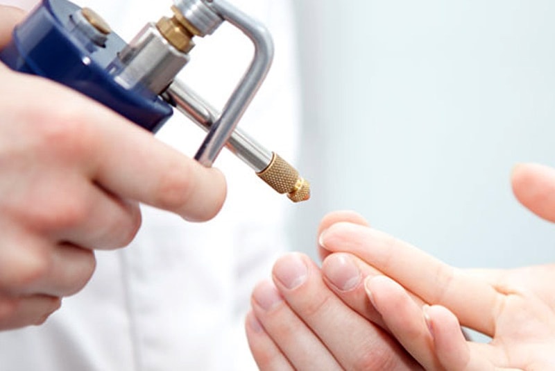 Криотерапия бородавки