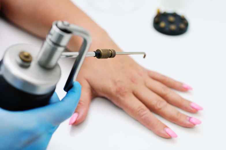 удаление бородавок жидким азотом в салоне