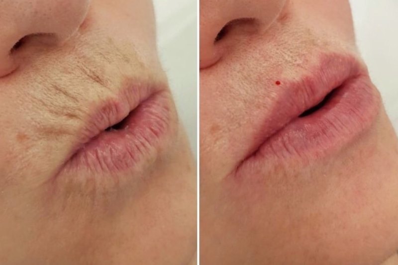 Ботокс губ: фото до и после