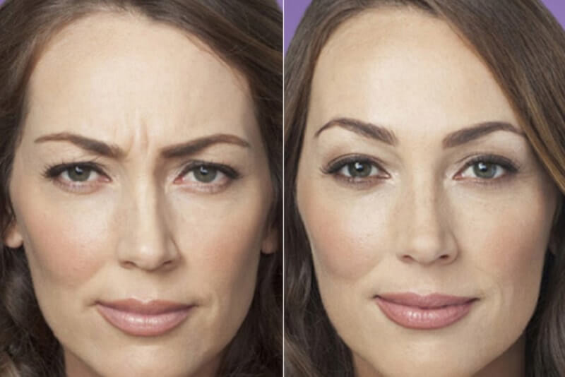 фото до и после диспорта