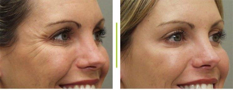 фото до и после ботокса для глаз